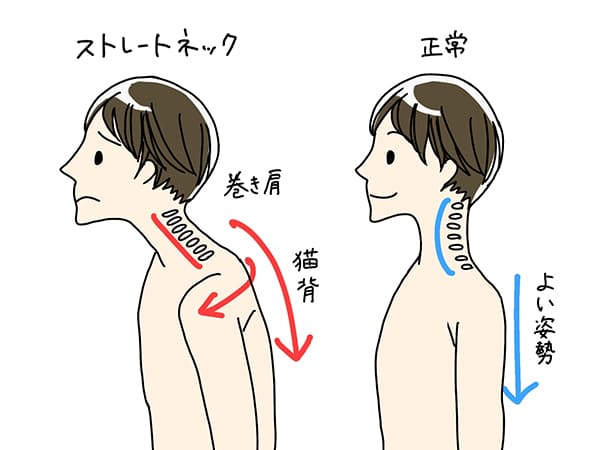 猫背と巻き肩