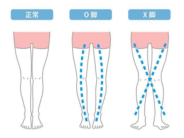 O脚・X脚